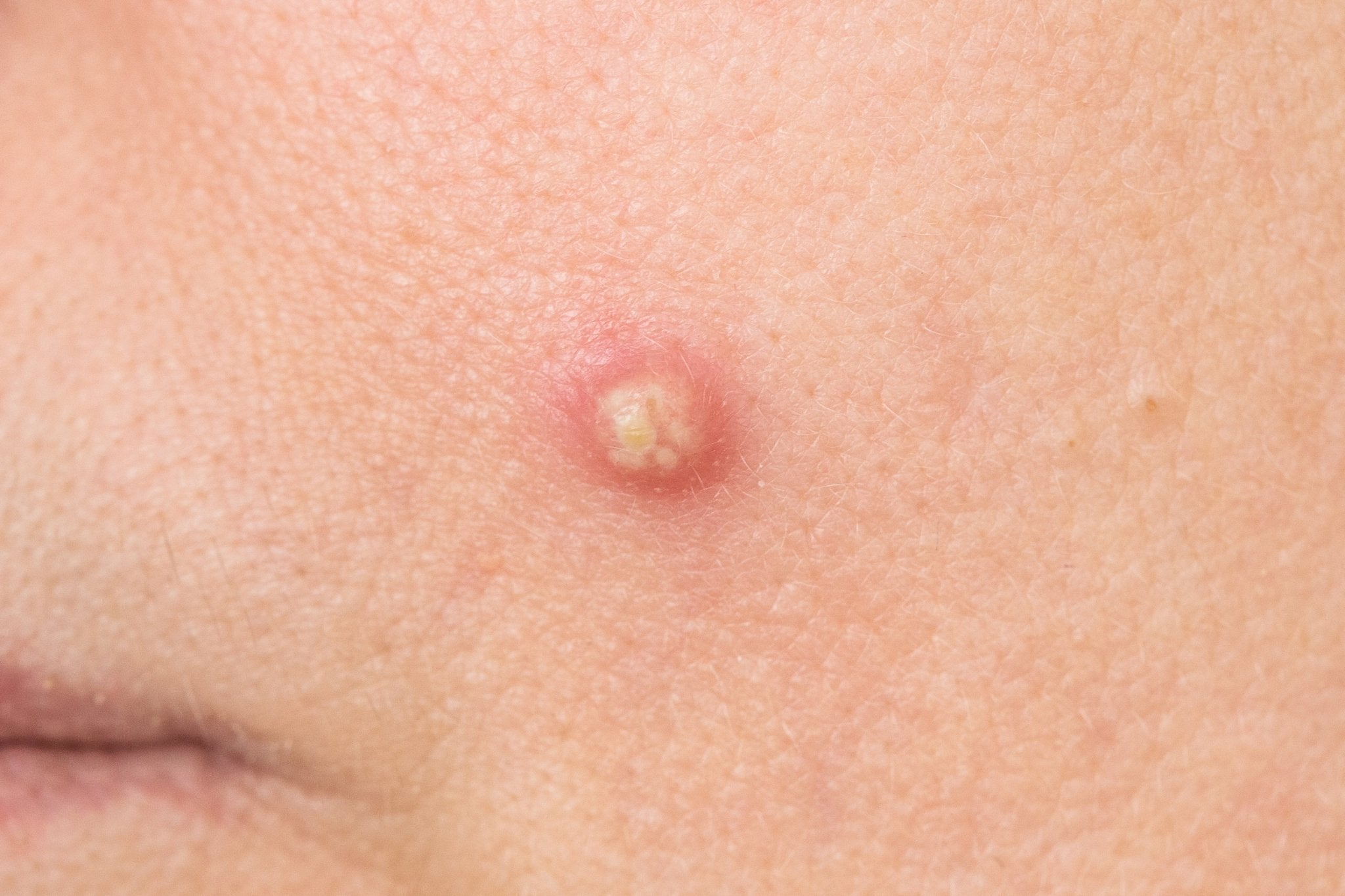 every type of zit, explained - cocokind